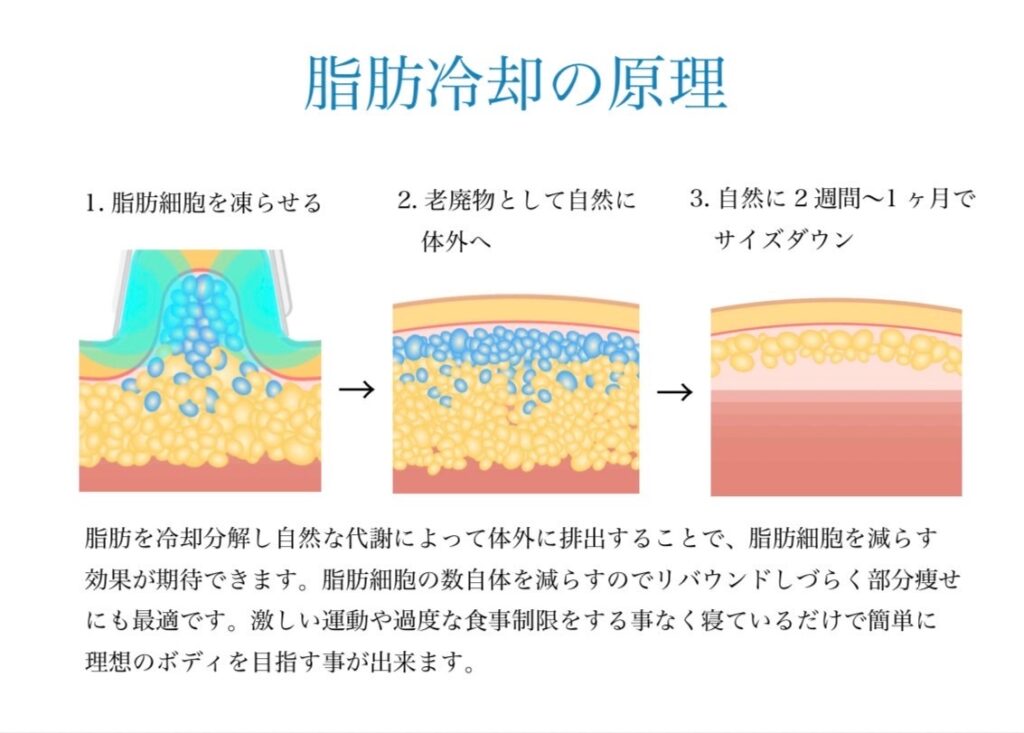 脂肪冷却の原理